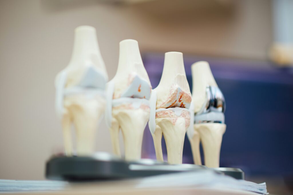 Why Is My Hip Replacement Hurting After 5 Years? Pain after hip surgery