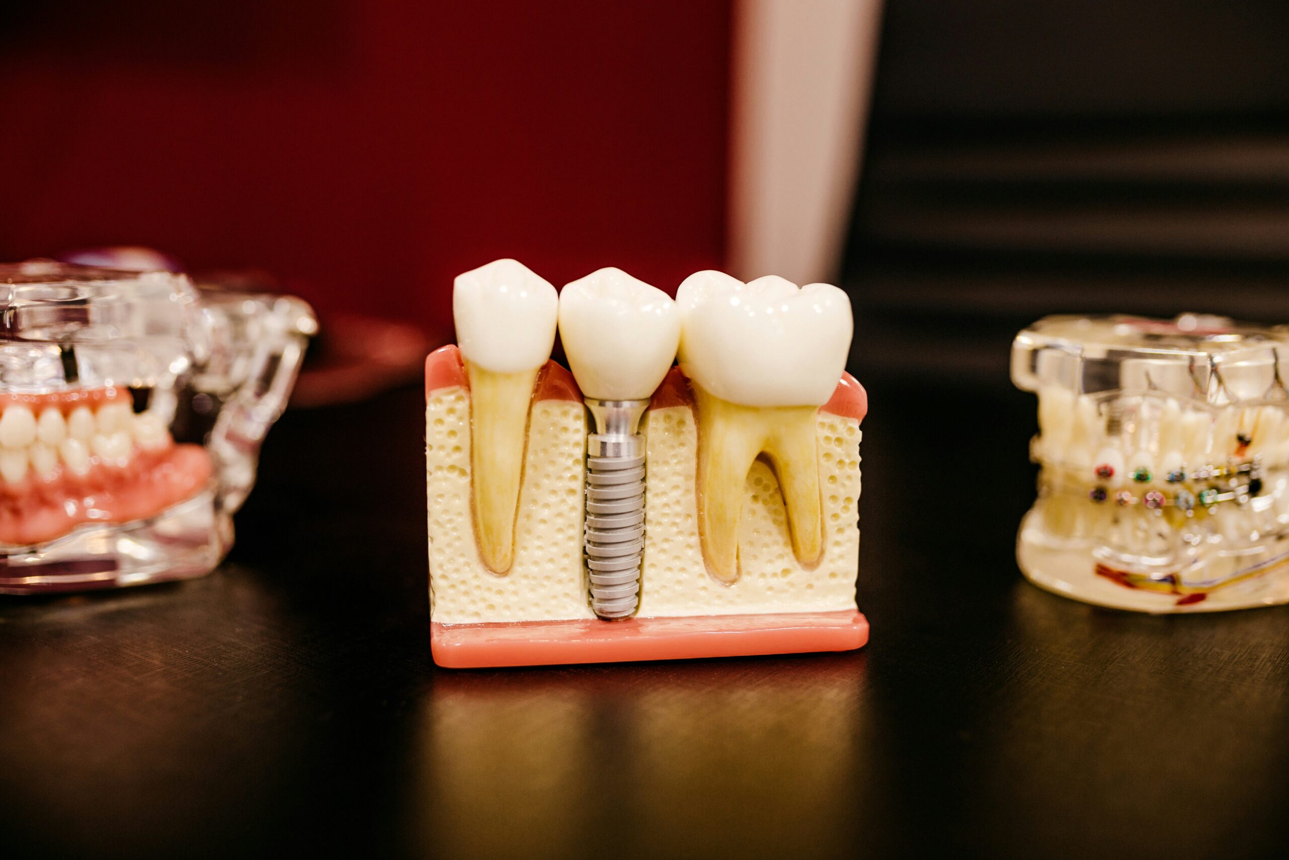 Why Are Dental Implants So Expensive? Understanding the Real Cost