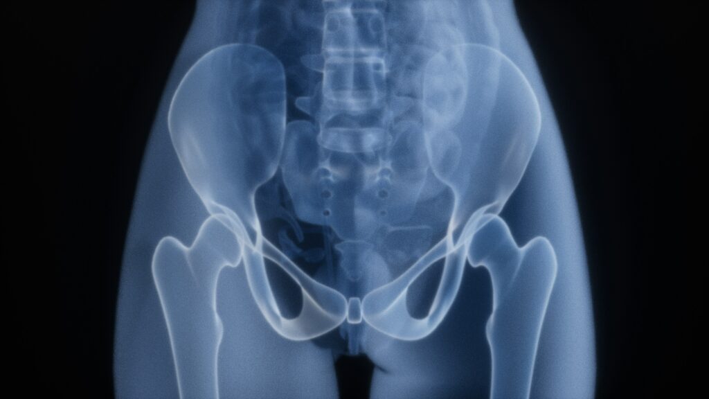 Why Is My Hip Replacement Hurting After 5 Years? Hip replacement pain explained